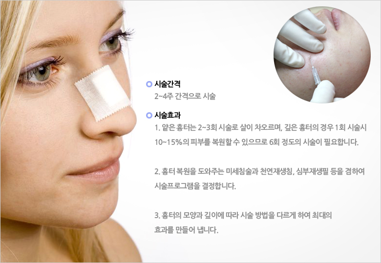 여드름 한방치료